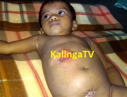 Odisha girl child with imperforate anus awaits government support 