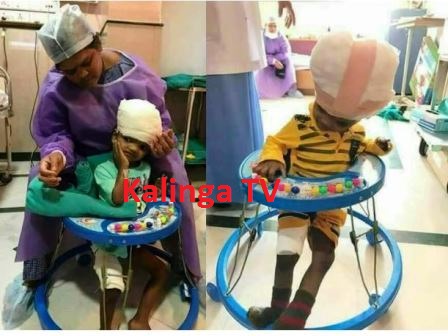 This is how separated conjoined twins Jaga walks 