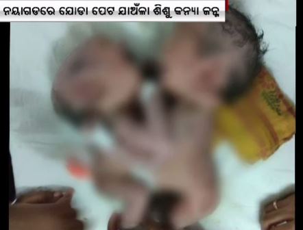 After Jaga-Balia another conjoined twins born in Odisha