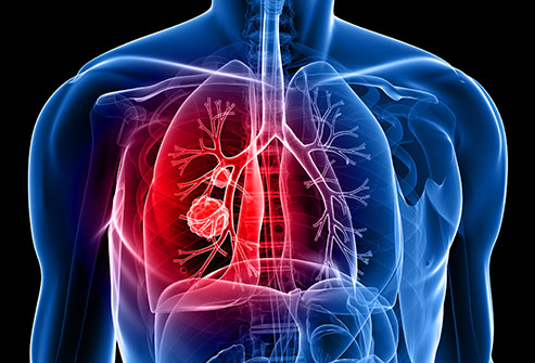 ai tool to predict lung cancer