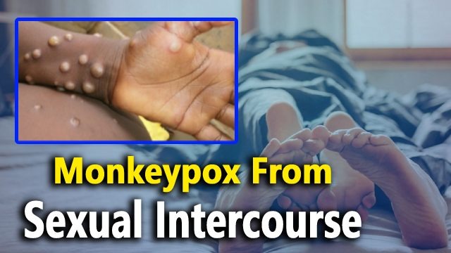 Monkeypox from sexual intercourse