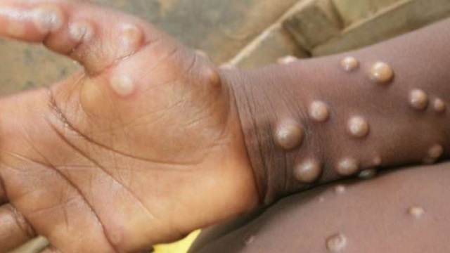canada monkeypox cases