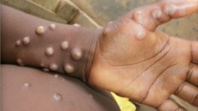 community transmission of monkeypox