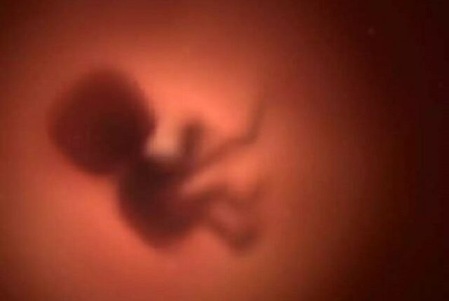 Unborn twin removed from brain