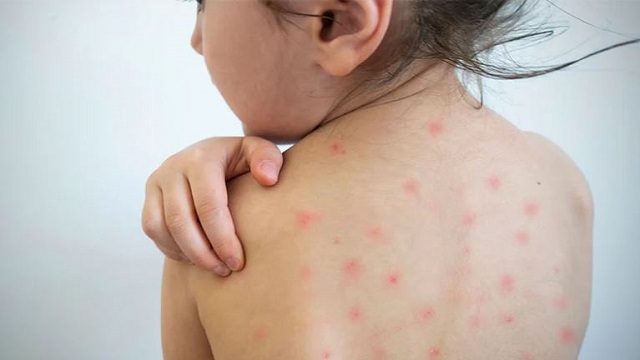 measles outbreak in maharashtra