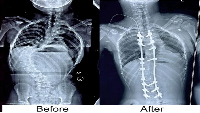 complex spine surgery at kims