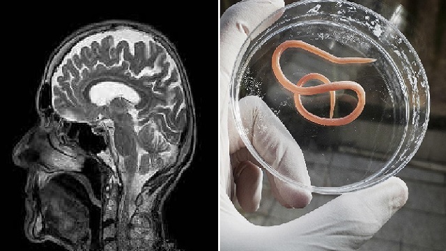 Live 8cm worm in woman's brain