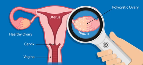 Genetics to find ovarian cancer