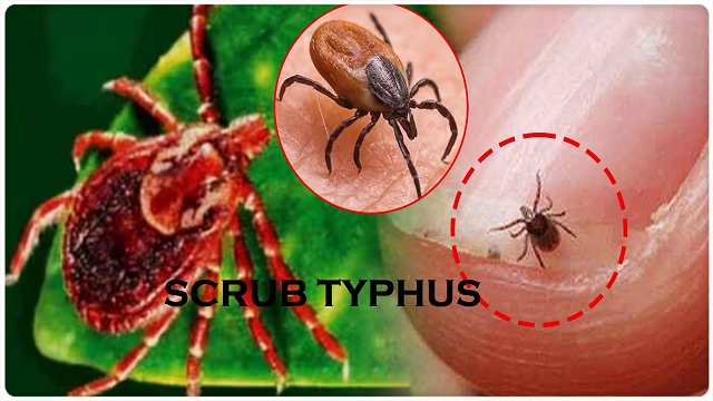scrub typhus in odisha
