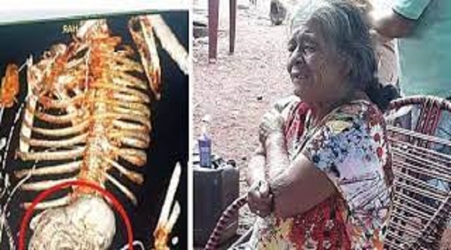 Brazilian woman carried dead foetus for 56 years