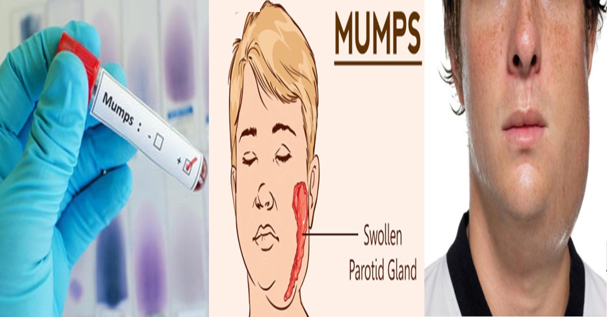rise in cases of mumps