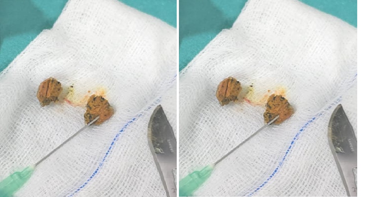 doctors remove turmeric lungs